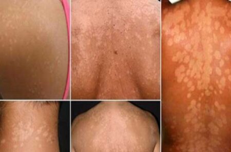 No more dartres on the body