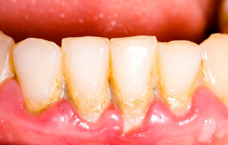 Visible appearance of tartar on the teeth