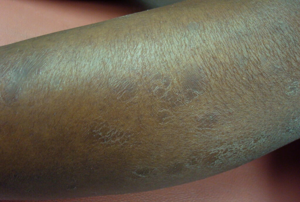 Etat d'une peau sèche