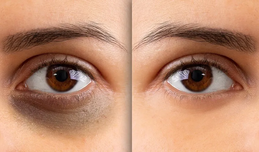 Eyes with and without dark circles