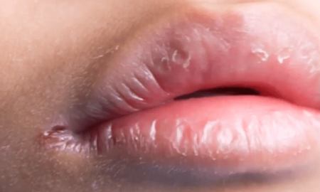 crack at the corner of the lips