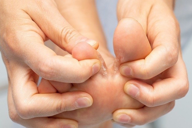 How to treat athlete's foot