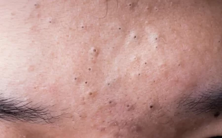 Comment enlever les points noirs