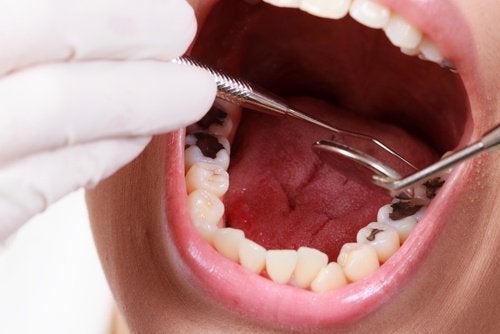 How to naturally relieve tooth decay?